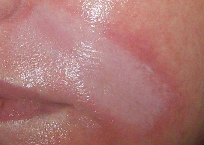 Ácido hialurônico para lábios: revisões, fotos antes e depois