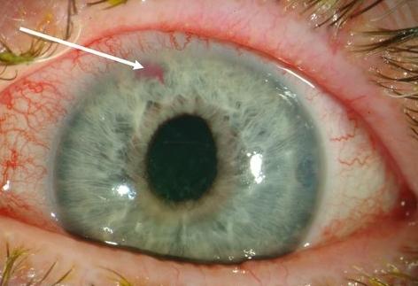 sintomas de glaucoma