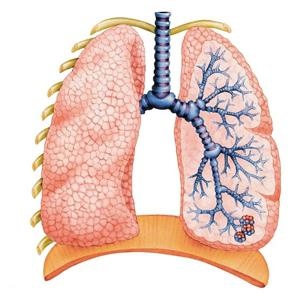 Doença pulmonar obstrutiva crônica - uma ameaça à vida dos usuários de tabaco