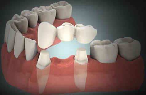 implantes dentários