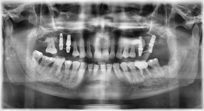 quanto é um implante dentário