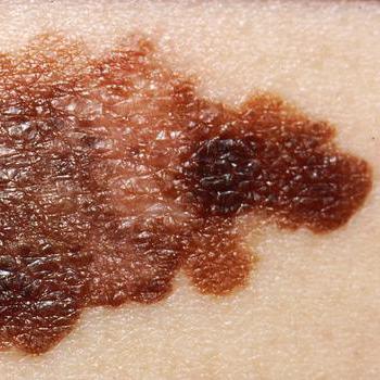 Melanoma cutâneo: expectativa de vida após a cirurgia