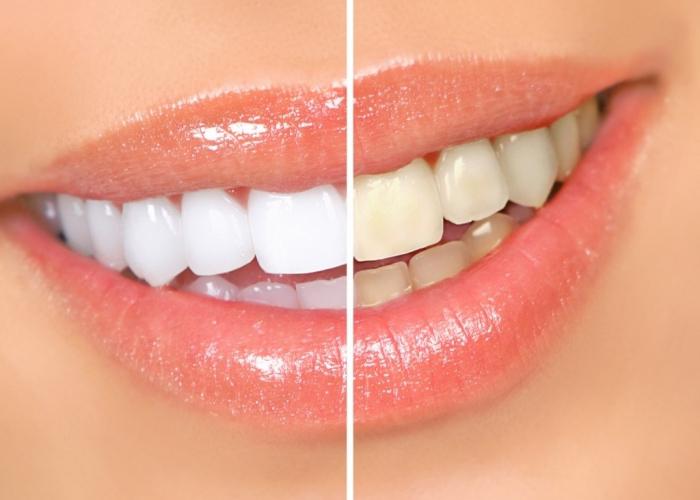 Uma maneira incomum de usar peróxido de hidrogênio: clareamento de dentes