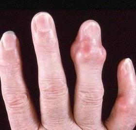 Os principais sintomas da artrite reumatóide