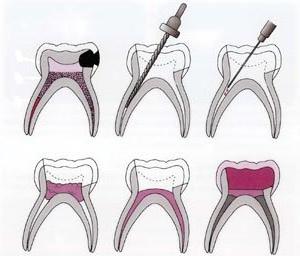 métodos de tratamento de pulpite
