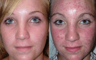 Álcool salicílico contra acne. Recursos do aplicativo