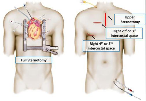 cirurgia de desvio cardíaco