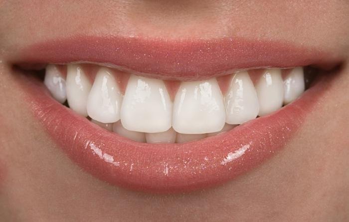 Folheados modernos nos dentes: o que é isso?